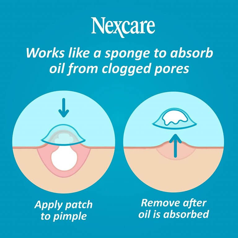 נקודות לטיפול בפצעונים ואקנה